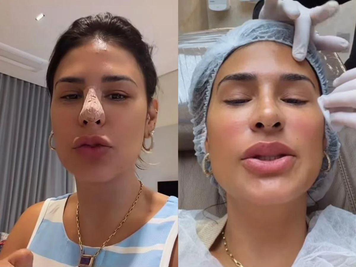 Simone Mendes surpreende ao aparecer com curativo no nariz e revela detalhes de procedimento