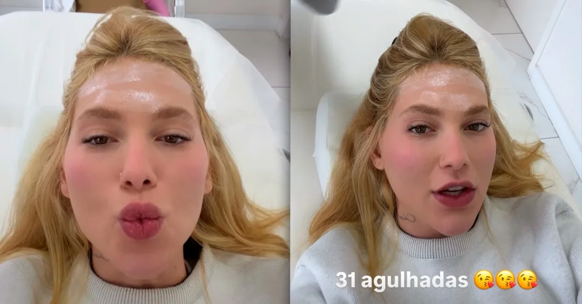 Por que Virginia Fonseca recebeu 31 aplicações de botox na cabeça?