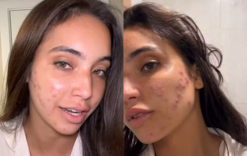 vanessa-lopes-acne-noticia-fm